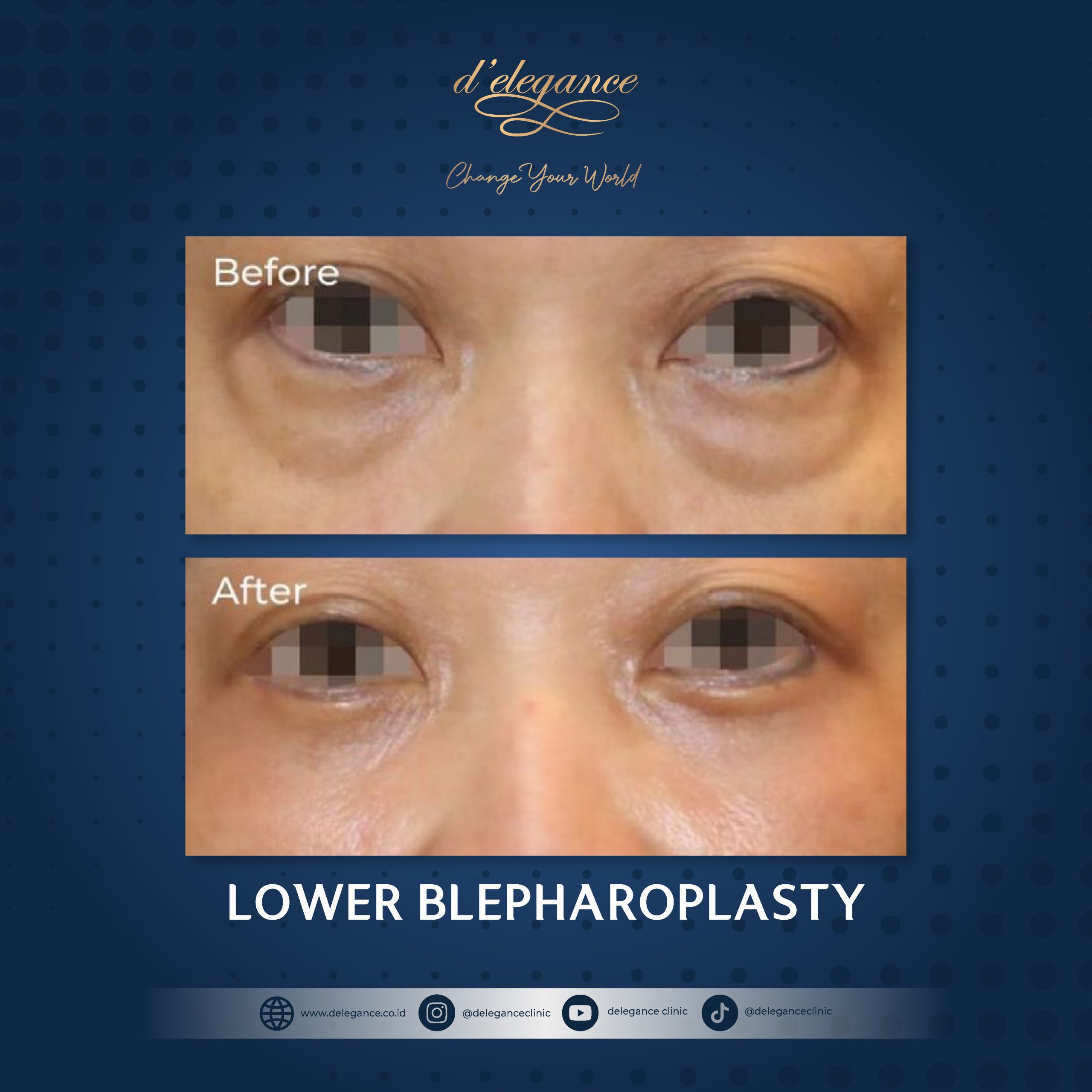 Before After Blepharo-02