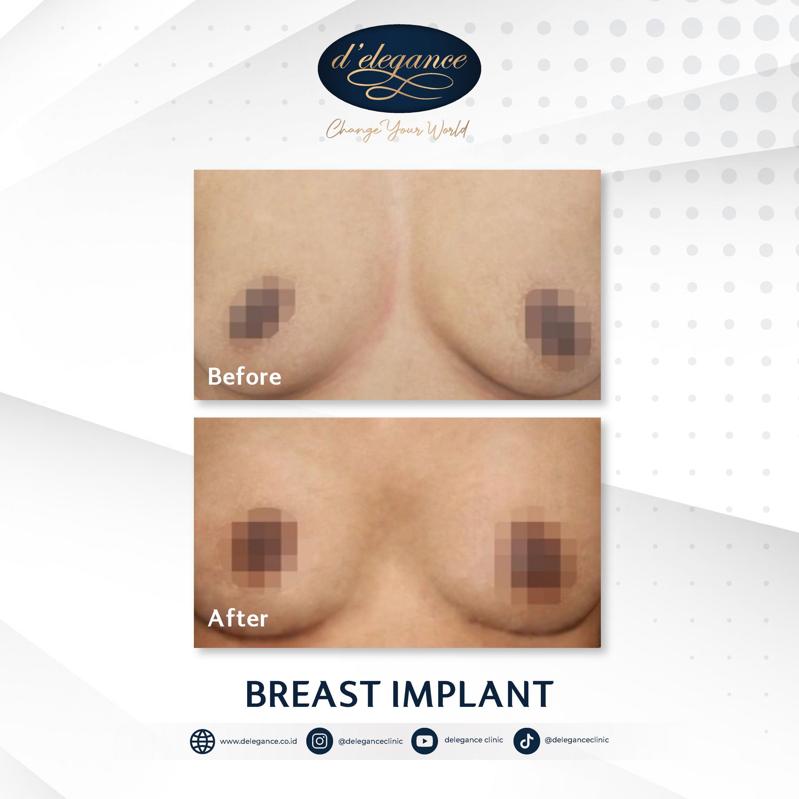 Before After Breast-04