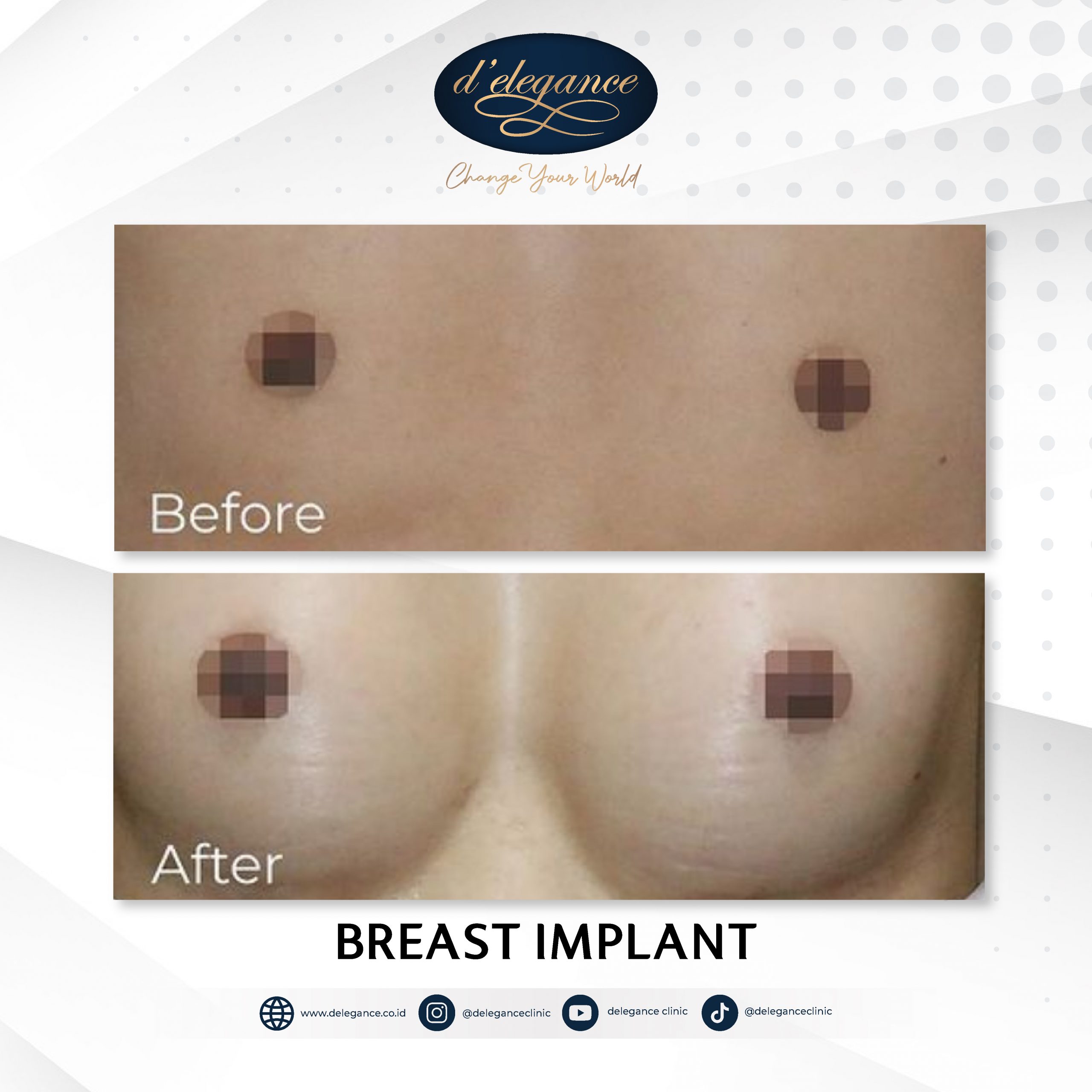 Before After Breast-06