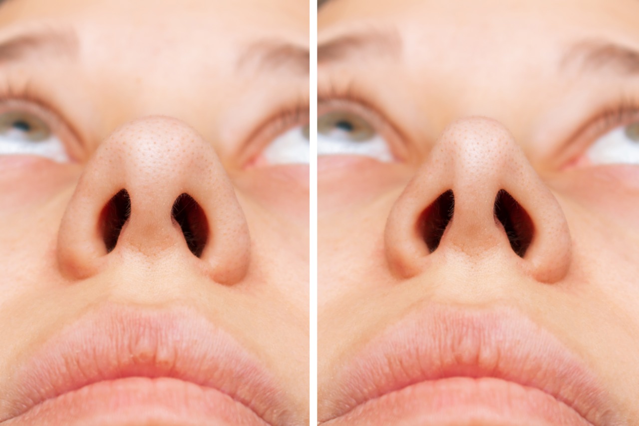 Rekonstruksi Hidung dengan Operasi Hidung Permanen