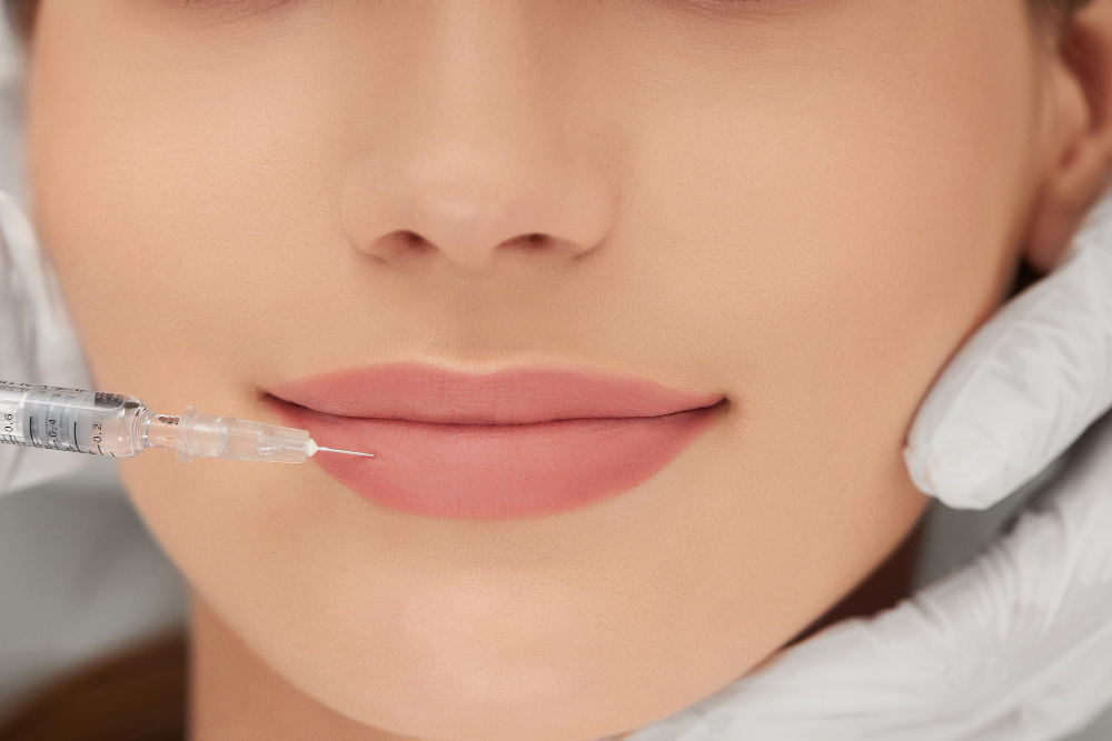Filler Bibir Salah Satu Treatment yang Bisa Membuat Bibir Tampak Berisi