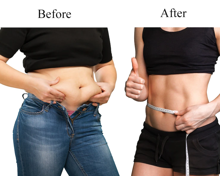 Yuk Kenali Prosedur Liposuction, Salah Satu Cara Hilangkan Lemak Tubuh!