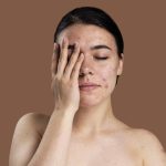 Kenali Perbedaan Acne Scar dan Dark Spot, Jangan Salah Perawatan