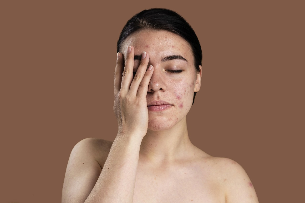 Kenali Perbedaan Acne Scar dan Dark Spot, Jangan Salah Perawatan